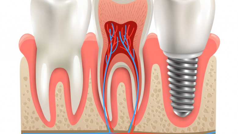 How Dental Implants Are Revolutionizing Smile Restoration in Dubai