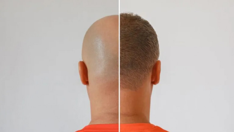 Innovation in Every Follicle: Healing After Hair Transplants