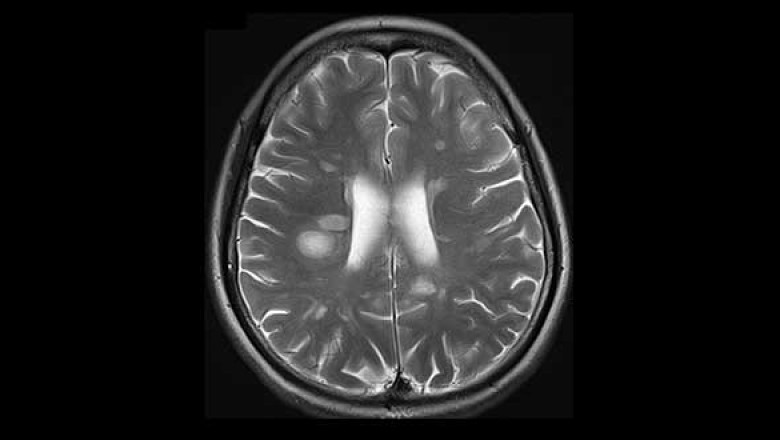 Neuromyelitis Optica Market Buoyed by Monoclonal Antibody Therapies