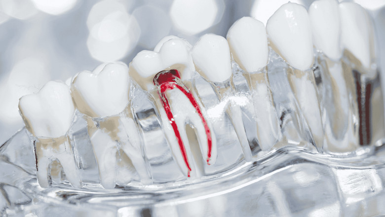 Root Canal Treatment Cost in the UK: Everything You Need to Know