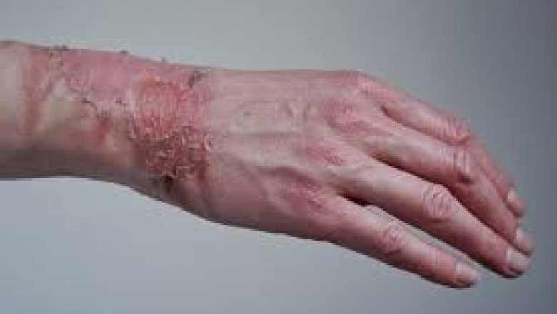 Skin Replacement Market Opportunities and Threats Impacting Industry Players Today