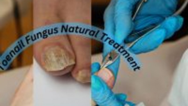 Toenail Fungus Natural Treatment: A Comprehensive Guide