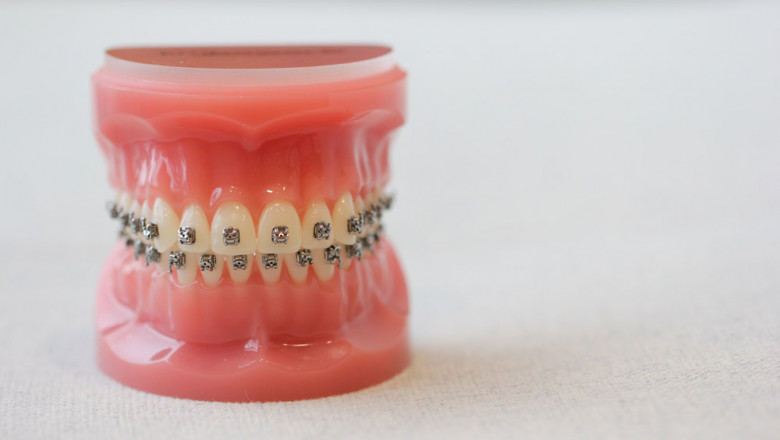 Transform Your Smile with Invisalign and Braces: Advanced Orthodontic Solutions for All Ages