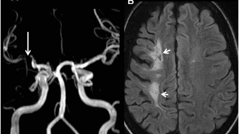 Transient Ischemic Attack Market Poised for AI Diagnostics Growth