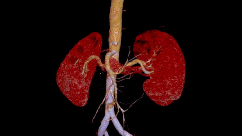 Alport Syndrome Market Anticipated to Witness High Growth Owing to Novel Therapeutic Advancements