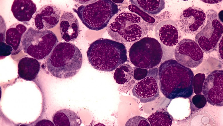 Aplastic Anemia Market is Anticipated to Witness Growth Owing to Novel Therapies
