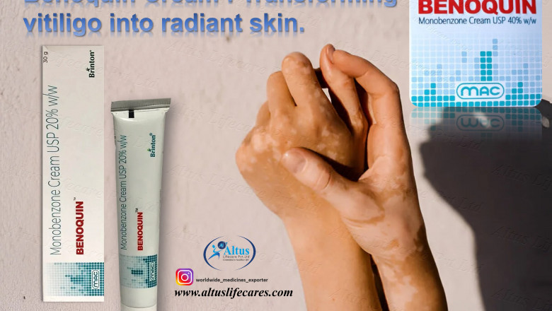 Benoquin 20% Monobenzone Cream The Breakthrough Solution for Vitiligo You Need!