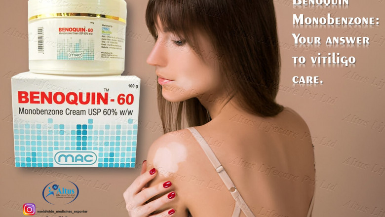 Can Benoquin 60% Cream Really Erase Vitiligo? The Results Are Shocking!
