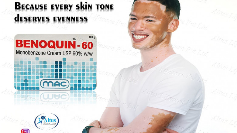 He Tried Benoquin 60% Cream for Vitiligo – You’ll Never Guess What Happened Next!