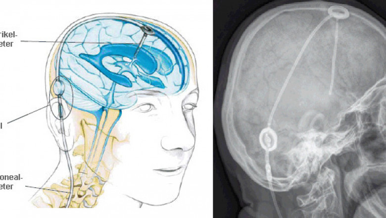Hydrocephalus Shunts Market Estimated to Rise with Programmable Valves