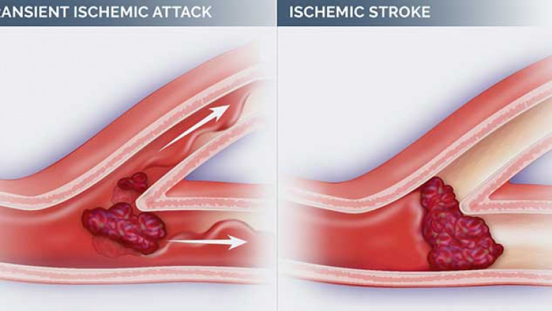 Ischemic Stroke Pipeline Market Is Set to Soar with Innovative Neuroprotective Therapies