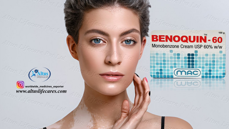 Monobenzone 60% Cream Changed Her Skin Forever!