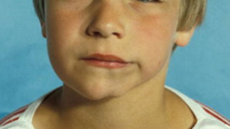 Parry Romberg Syndrome Market Thrives on AI-driven Diagnostic Imaging