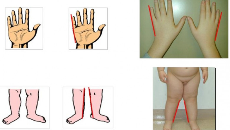 Prader-Willi Syndrome Market to Benefit from Advanced Gene Therapy