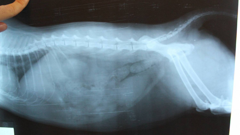 Urolithiasis Management Devices Market Witnesses Growth Owing to Laser Lithotripsy