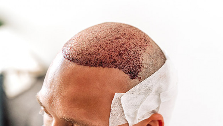 Hair Transplant Success: Factors Influencing Outcomes
