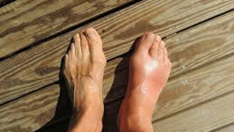 Acute Gout Flare Therapeutics Market is Estimated to Witness High Growth Owing to Monoclonal Antibody-based Therapies
