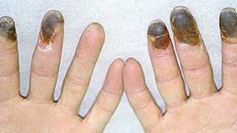 Buerger’s Disease Market Set to Surge with Innovative Cell Therapies