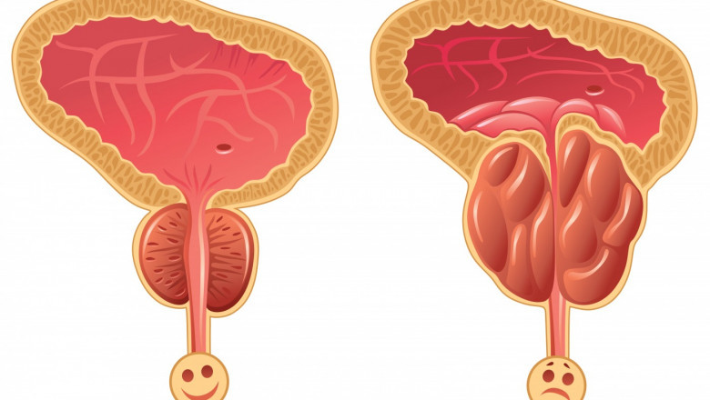 Neuroendocrine Prostate Cancer Market is Anticipated to Witness High Growth Owing to Innovative Therapeutics