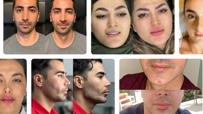 Revitalize Your Look with a Non-Surgical Face Lift in Culver City — Safe, Natural, and Effective Rejuvenation