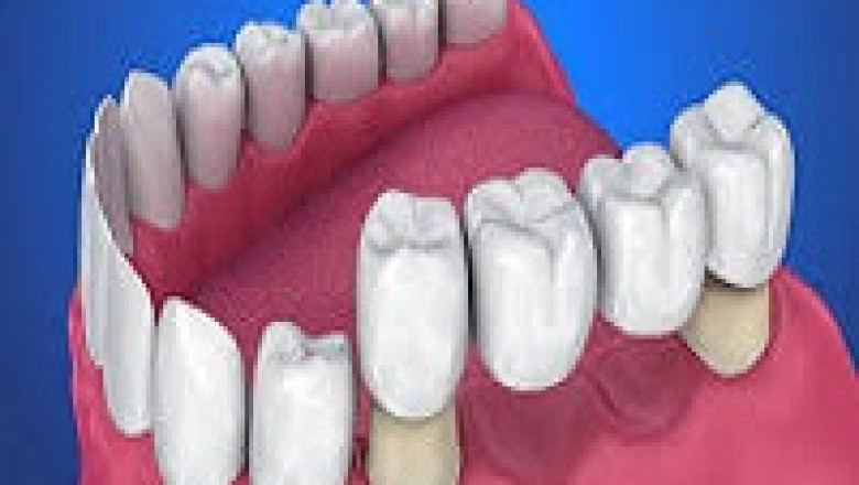 Affordable Dental Veneers Services in USA