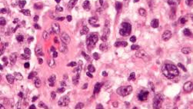 Anaplastic Large Cell Lymphoma Treatment Market to Grow on Targeted Therapies