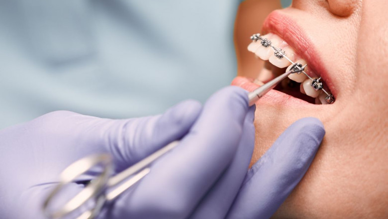 Braces Cost in Sydney: What You Can Expect to Pay in 2025