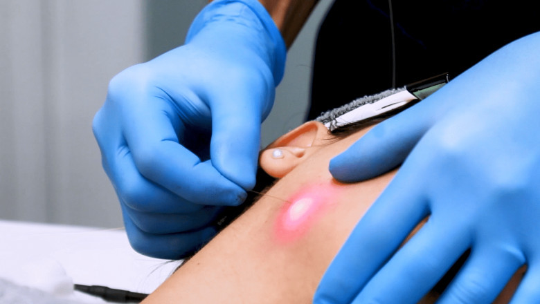 Can Endolift be used on the cheeks?