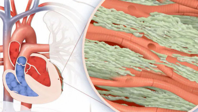 Cardiac Amyloidosis Market to Grow at Highest Pace Owing to RNA Therapies