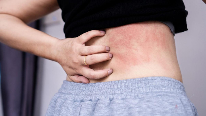 Chronic Spontaneous Urticaria Market is Anticipated to Witness High Growth Owing to Biologic Therapies