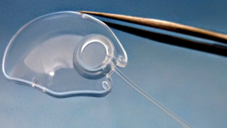Glaucoma Drainage Devices Market to Surge Owing to Rapid Innovation