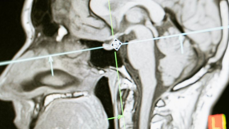 Global Brain Imaging Devices Market Report 2032