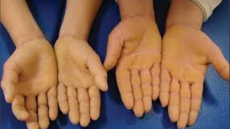 Palmoplantar Keratoderma Market Anticipated to Witness High Growth Owing to Rising Incidence of Skin Disorders