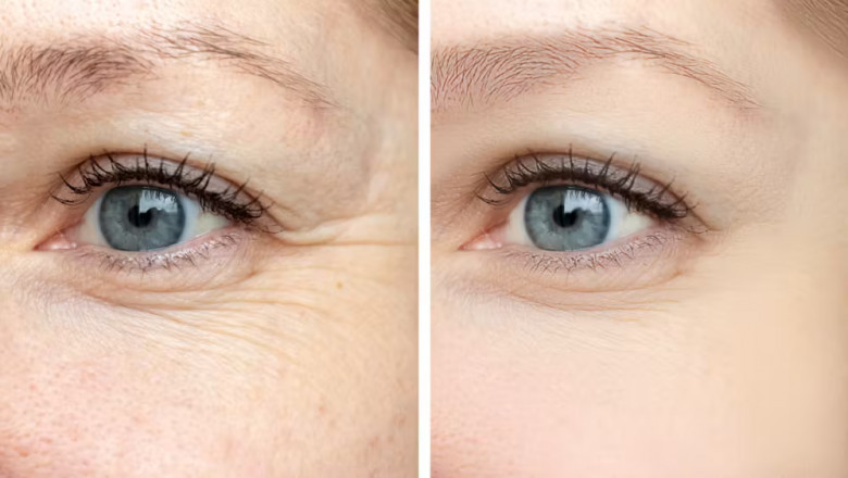 Rejuvenate Your Eyes: Upper Eyelid Surgery Options in Delhi