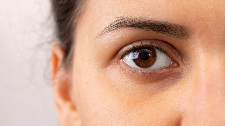 Bright Eyes: Effective Dark Circle Treatments