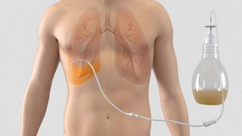 Chest Drainage Catheters Market to Expand on Rising Infections