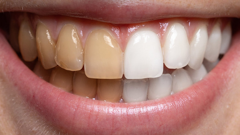 First-Time Clients Drive Demand for Oral Aesthetic Whitening
