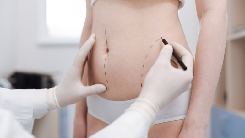 Liposuction Surgery: Long-Term Results