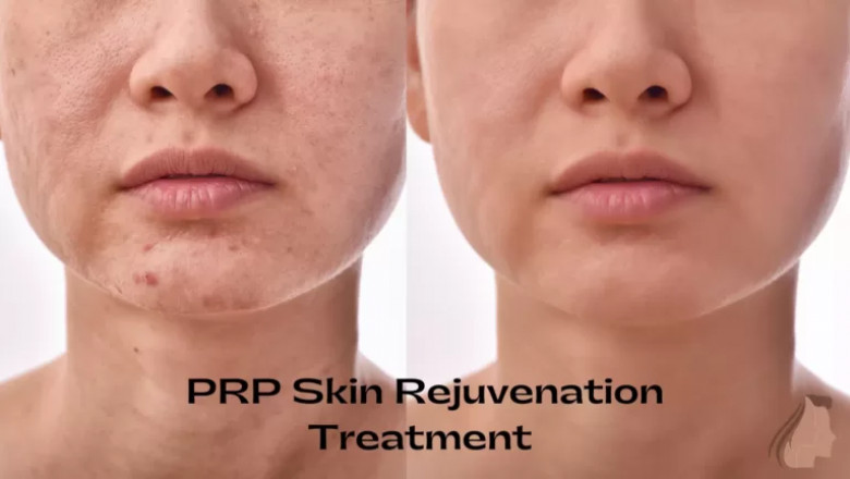 PRP Face Treatment: Rejuvenate Skin Naturally &amp; Safely