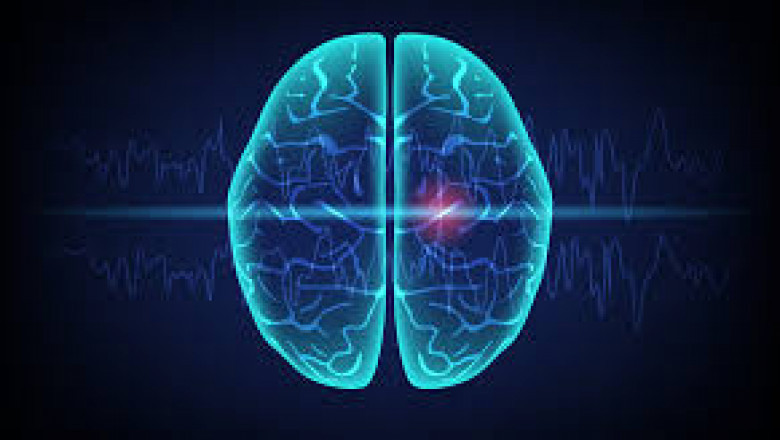Refractory Epilepsy Market to Surge Owing to Innovative Antiepileptic Therapies