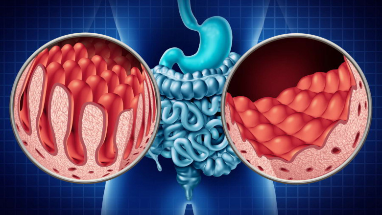 The Rise of Celiac Disease Drugs: What Rizevax Means for Patients