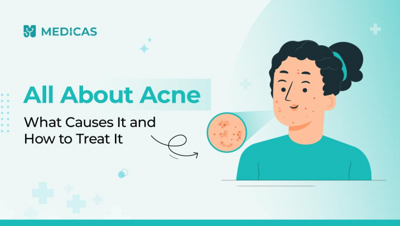 Understanding Acne: Causes, Treatments, and Myths