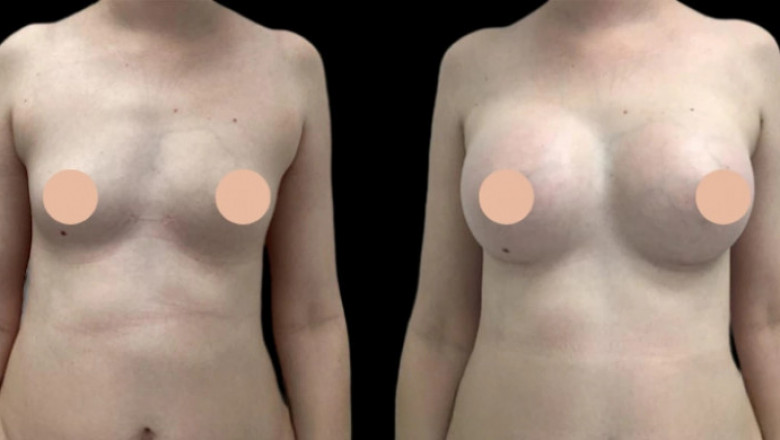 Do’s and Don’ts Before Meeting the Best Breast Augmentation Surgeons in Dubai