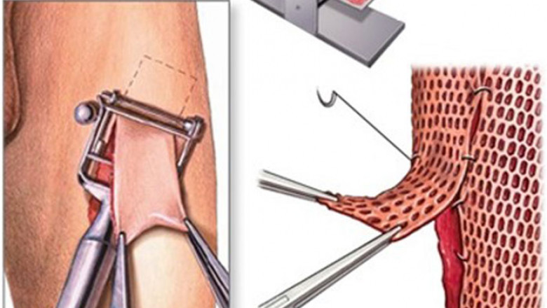 Global Skin Grafting Device Market to Surge with 3D Bioprinting