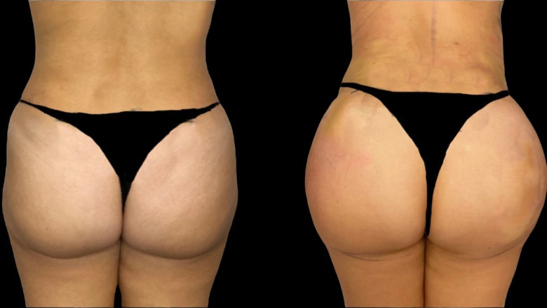 How the Best Butt Fat Transfer Surgeon in Dubai Can Enhance Your Body Contours