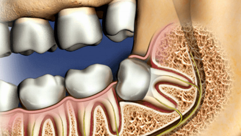 Tooth Extraction Cost Dubai: What’s Included in the Fee?