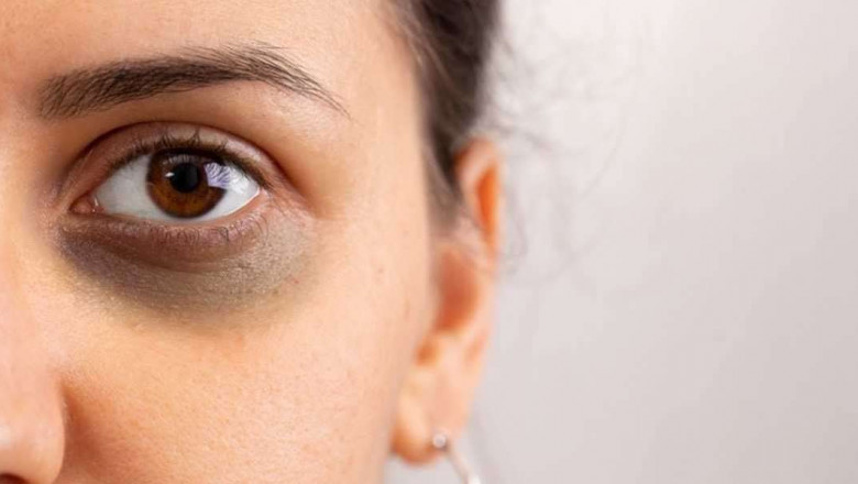 Dark Circle Treatment at Night Routine