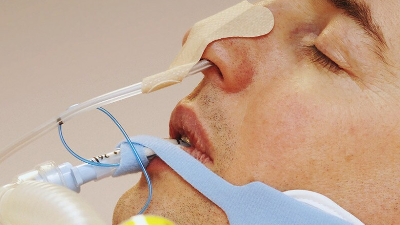 Global Feeding Tubes Market Anticipated to Witness High Growth Owing to Rising Chronic Diseases