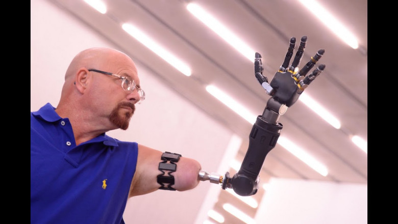 Global Robotic Prosthetics Market to Accelerate with AI Integration