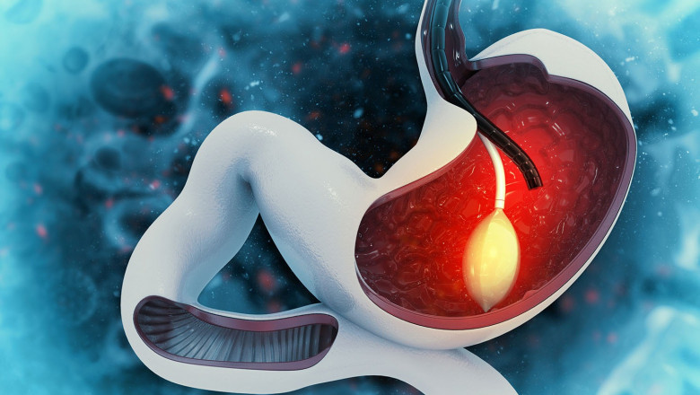 How Gastric Balloon Placement Helps You Lose Weight